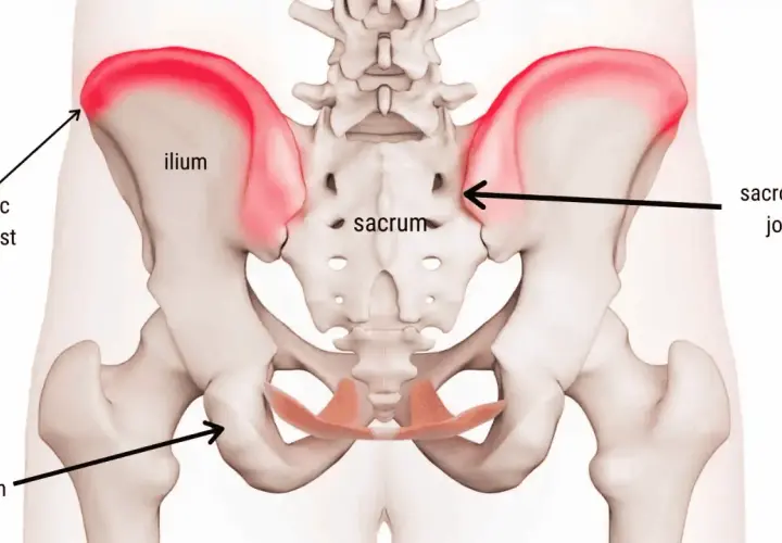 Anatomia del bacino con evidenziato il dolore alla cresta iliaca, sintomi comuni di infiammazione.