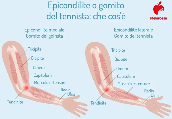Illustrazione anatomica che spiega epicondilite, o gomito del tennista, e epicondilite mediale, o gomito del golfista.