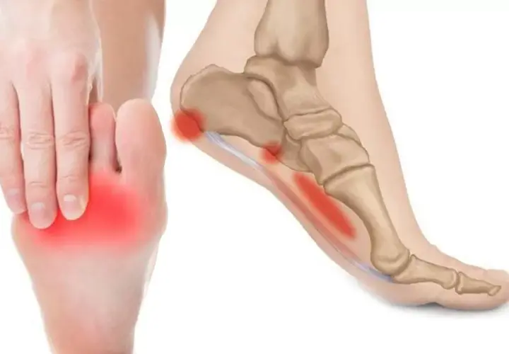 Dolore sotto tallone evidenziato in rosso su un piede e un'illustrazione anatomica.