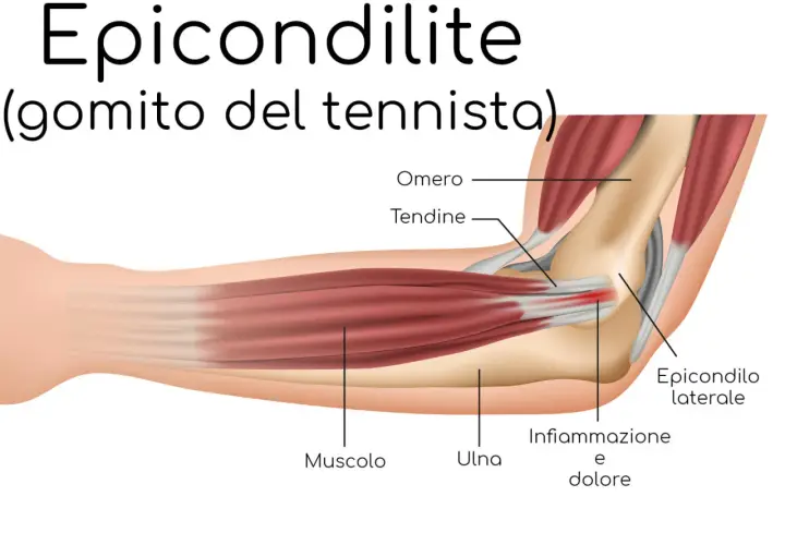 Illustrazione anatomica del gomito che mostra infiammazione e dolore, causa comune del dolore avambraccio tennis.