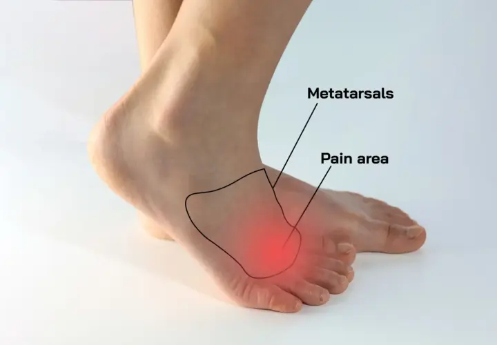Area dolente del metatarso, indicata per capire come sfiammare il neuroma di Morton.