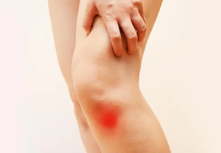 Dolore e bruciore al ginocchio interno, evidenziato da un'area rossa. La mano preme sulla zona dolente.