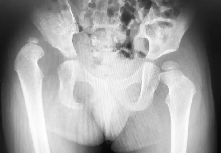 Radiografia del bacino e delle anche. Si nota una lussazione dell'anca, con implicazioni sui tempi di recupero.