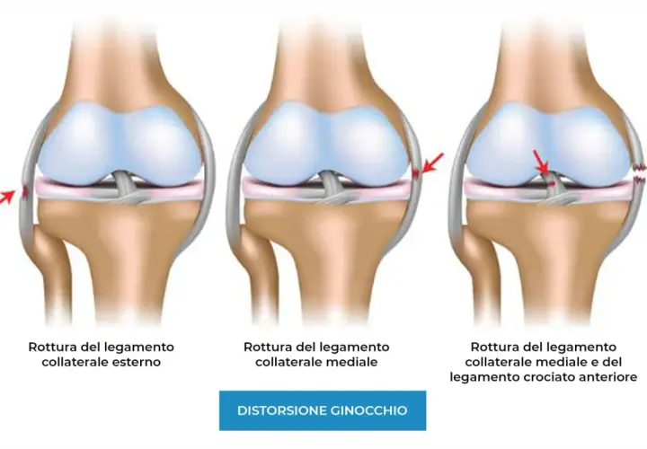 Illustrazione di ginocchia con lesioni ai legamenti: rottura del legamento collaterale esterno, mediale e crociato anteriore.