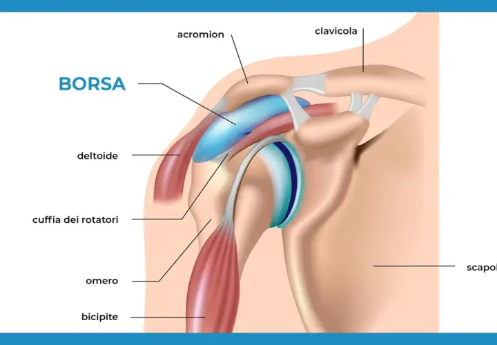 Illustrazione anatomica della spalla con etichette. Si vede la borsa, il deltoide, la cuffia dei rotatori, l'omero, il bicipite, l'acromion, la clavicola e la scapola.