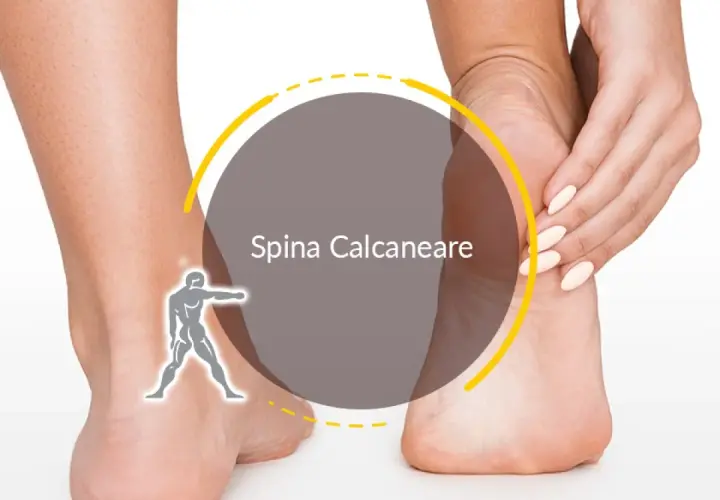 Dolore al tallone? La spina calcaneare può rendere difficile camminare, ma ci sono soluzioni.