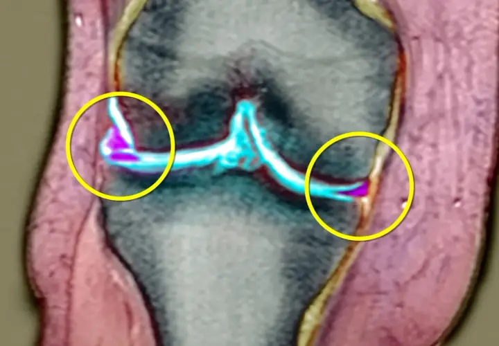 Risonanza magnetica del ginocchio evidenzia una lesione meniscale senza gonfiore, con aree di alterazione colorate in viola e blu.