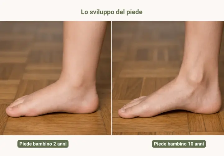 Confronto tra piede valgo di un bambino di 2 anni e di 10 anni, mostrando l'evoluzione della volta plantare.