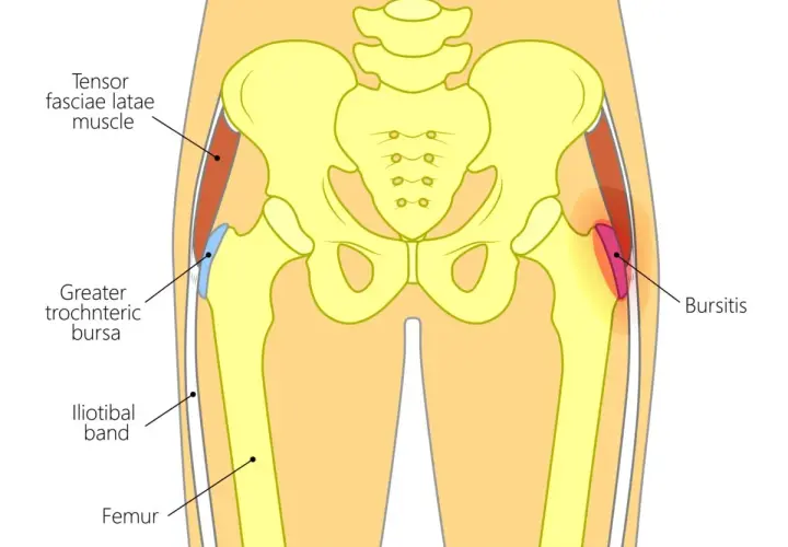 Illustrazione anatomica dell'anca che mostra la borsite trocanterica. Suggerimenti su come dormire con il dolore.