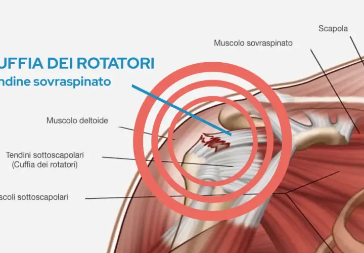 Illustrazione anatomica della spalla che evidenzia l'infiammazione della cuffia dei rotatori, in particolare del tendine sovraspinato.