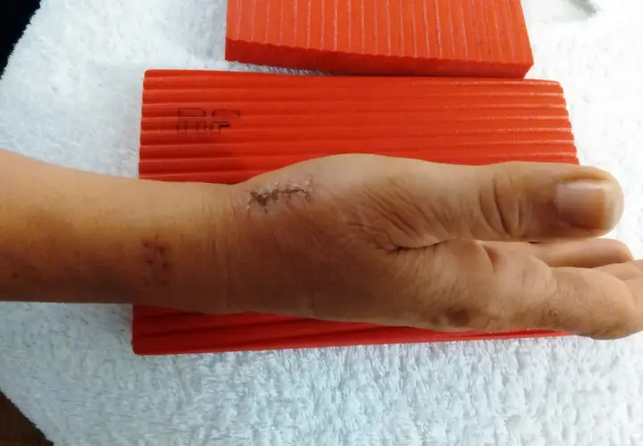 Mano con segni di sutura e taping per rizoartrosi pollice, appoggiata su asciugamano bianco con blocchi rossi.