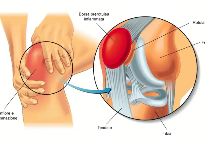 Ingrandimento di un ginocchio con gonfiore e infiammazione. La borsite al ginocchio è evidenziata, mostrando la borsa prerotulea infiammata.