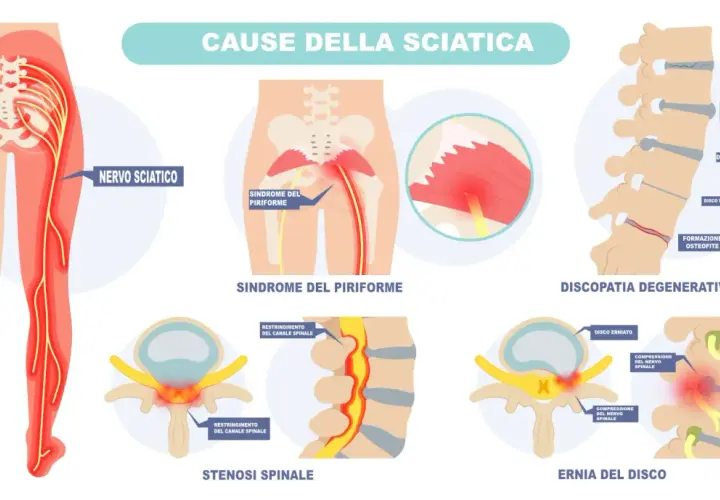 Illustrazione delle cause della sciatica: sindrome del piriforme, discopatia degenerativa, stenosi spinale ed ernia del disco, che provocano dolore al nervo sciatico.