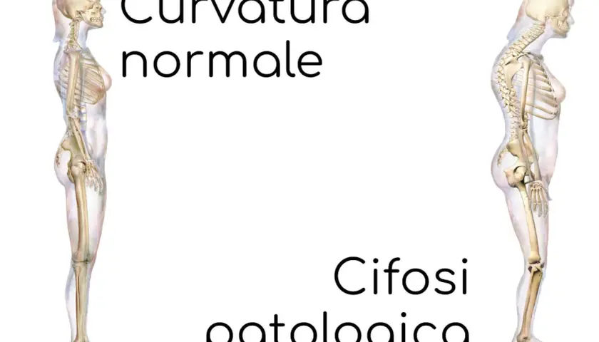 Scheletri a confronto: uno con curvatura normale, l'altro con cifosi patologica, evidenziando la curvatura lombare alterata.