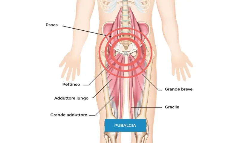 Anatomia della pubalgia: focus su psoas, pettineo, adduttori e gracile. Scopri come curare la pubalgia velocemente con esercizi mirati.