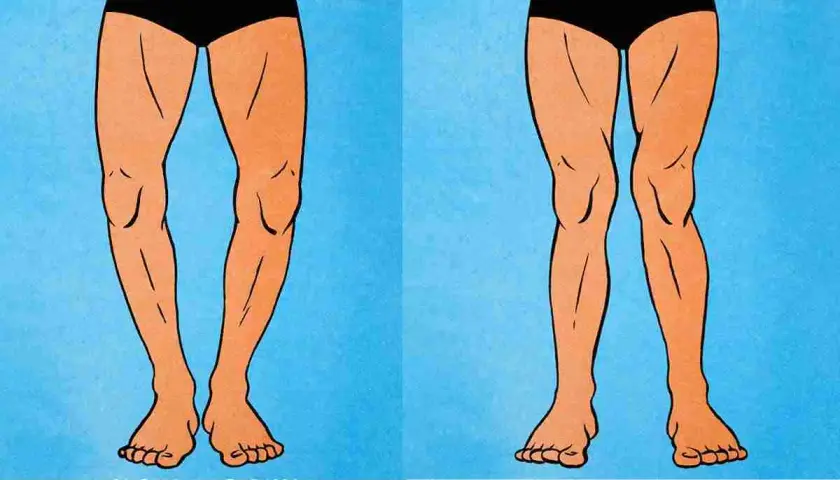 Gambe con valgismo (ginocchia a X) e varismo (ginocchia arcuate). Confronto visivo tra le due condizioni.