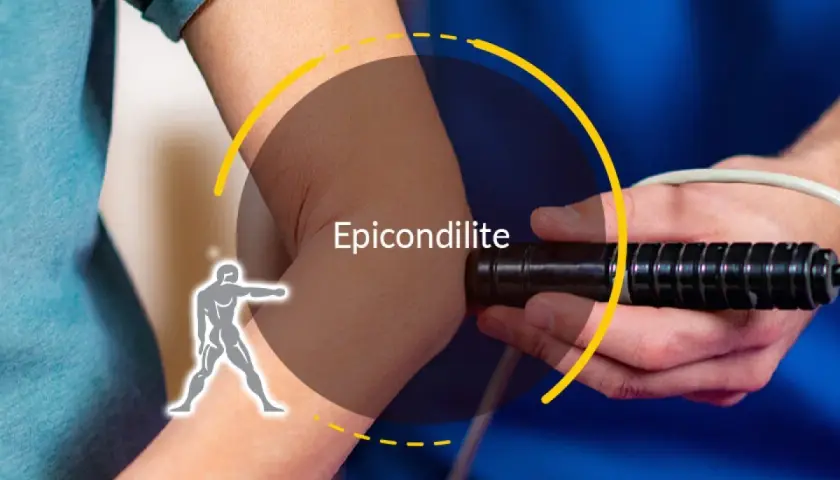 Trattamento per epicondilite: un dispositivo medico applicato al gomito per alleviare il dolore.