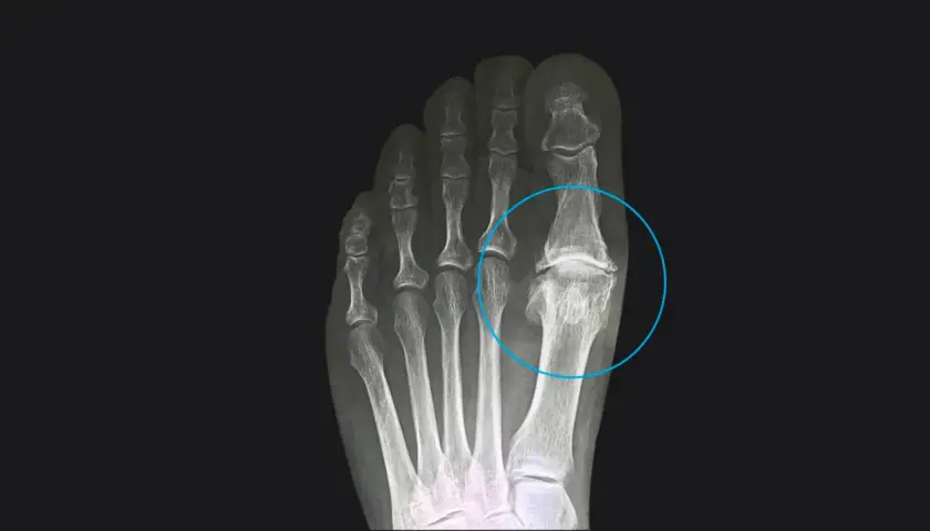 Radiografia del piede che evidenzia l'alluce rigido, con deformità e fusione ossea nell'articolazione metatarso-falangea.