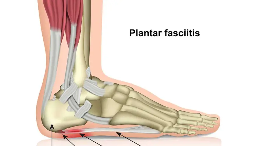 Anatomia del piede con fascite plantare, infiammazione del tallone. Il magnesio può aiutare.