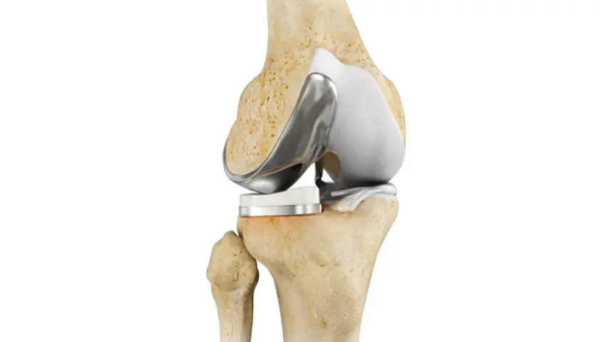 Protesi al ginocchio: un'immagine anatomica che mostra la sostituzione articolare. Quanto dura il dolore dopo la protesi al ginocchio?