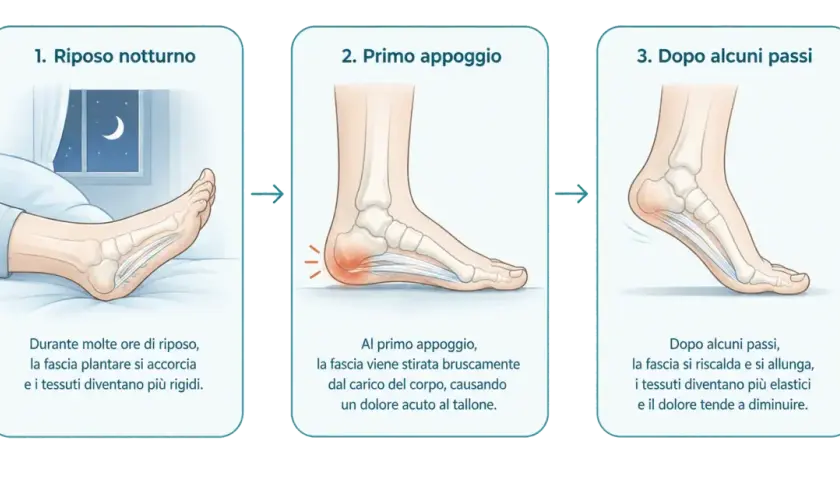 Il dolore al tallone peggiora al mattino, un classico della fascite plantare che non passa. L'immagine mostra come la fascia plantare si irrigidisce durante il riposo e si infiamma al primo passo.