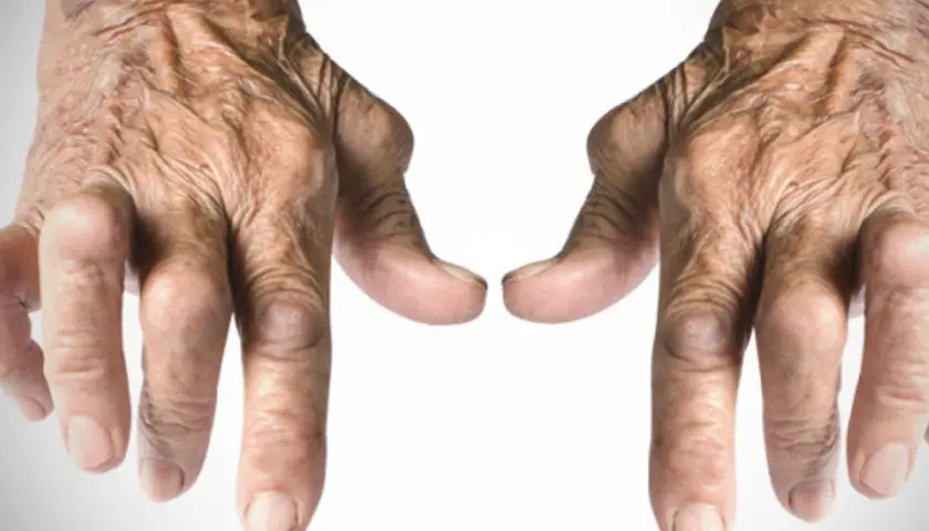 Mani con segni di rizoartrosi. Il freddo o il caldo possono influenzare il dolore.