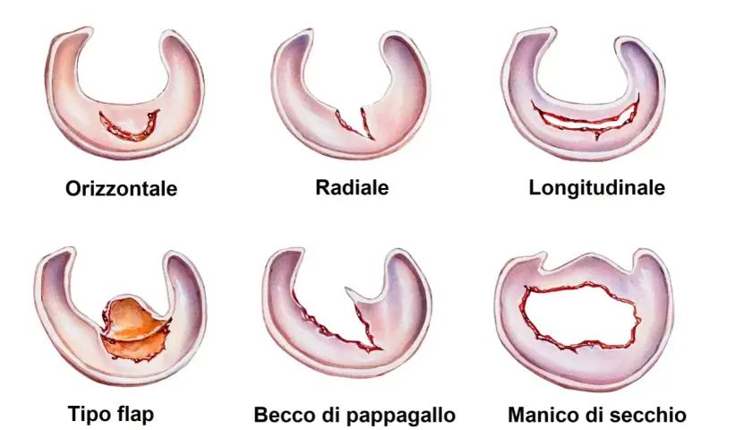 Illustrazioni di vari tipi di menisco rotto: orizzontale, radiale, longitudinale, a lembo, a becco di pappagallo e a manico di secchio.