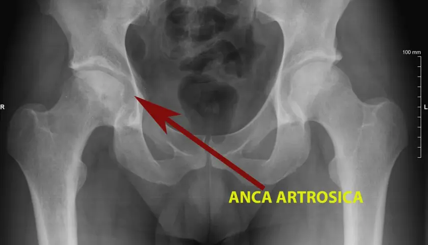 Radiografia del bacino che mostra un'anca artrosica, con freccia rossa che indica l'area interessata.
