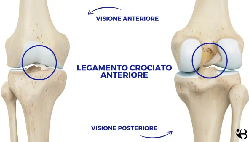Legamento crociato anteriore rotto in visione anteriore e posteriore del ginocchio.