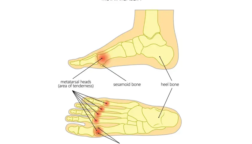Illustrazione anatomica del piede che mostra l'infiammazione metatarso, con aree di dolorabilità evidenziate nelle teste metatarsali.
