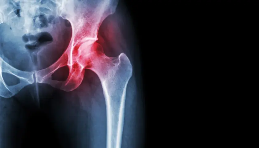Radiografia del bacino con evidenza di trocanterite. Camminare fa bene per migliorare la mobilità dell'anca.