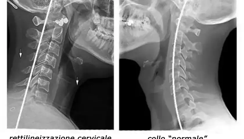 Radiografie cervicali: a sinistra, rettilineizzazione del rachide cervicale con frecce che indicano possibili conseguenze; a destra, collo "normale".