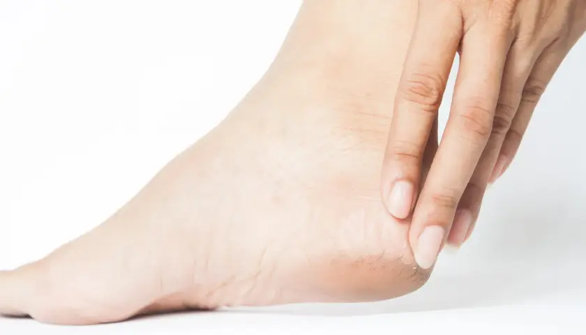 Dita sfiorano un tallone con pelle secca e screpolata, sintomo di spina calcaneare.