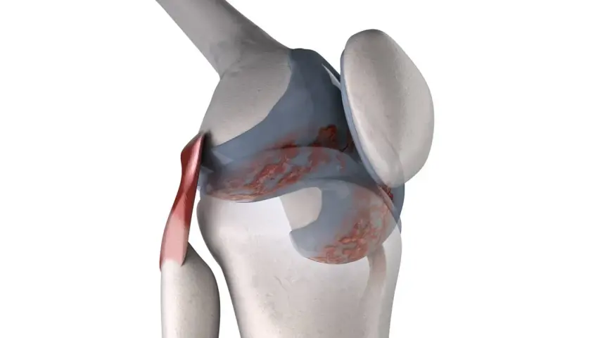 Dettaglio anatomico di un ginocchio con cartilagine danneggiata, che suggerisce ginocchia che scricchiolano.