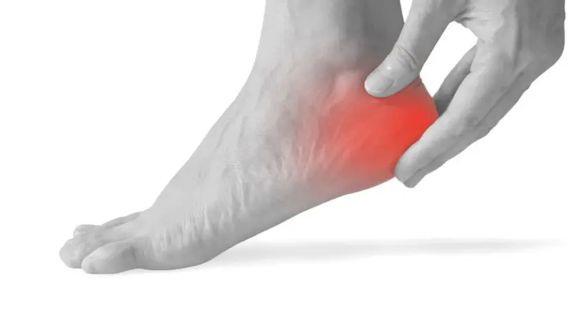 Piede con dolore al tallone, evidenziato in rosso. Utile per illustrare spina calcaneare esercizi.