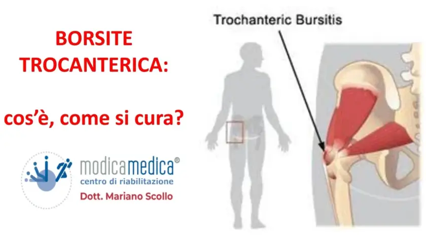 Borsite trocanterica che non passa? Immagine illustra la condizione e le opzioni di cura.