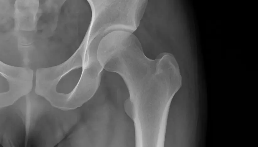 Radiografia dell'anca che mostra una calcificazione ossea.