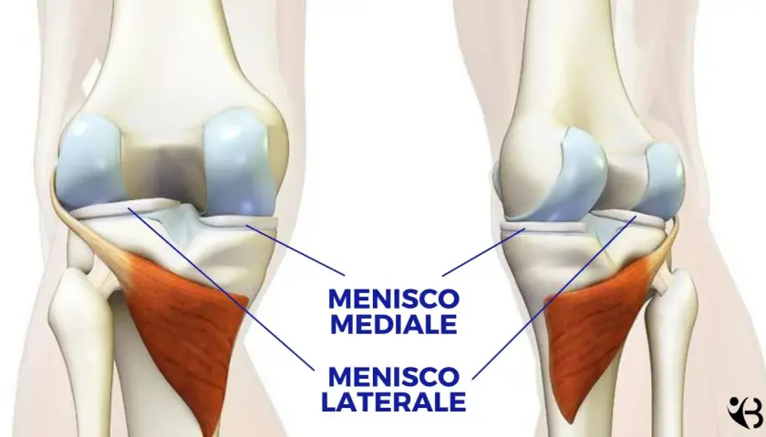 Illustrazione anatomica del ginocchio che evidenzia il menisco mediale e il menisco laterale, strutture cartilaginee essenziali per la stabilità e il movimento.