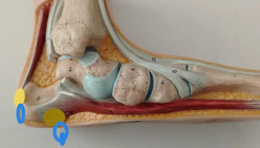 Modello anatomico del piede evidenzia la spina calcaneare trascurata, con aree di interesse cerchiate in giallo e blu.