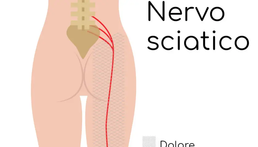 Illustrazione anatomica del nervo sciatico e del lombo cruralgia. Il dolore si irradia lungo la gamba.