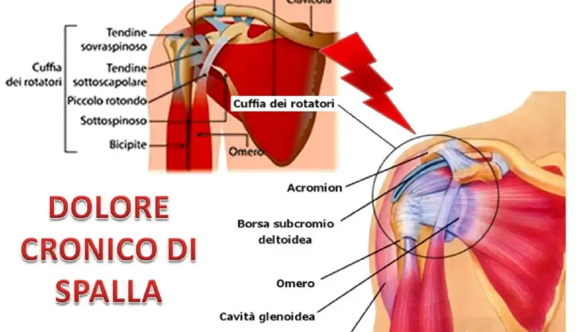 Dolore cronico di spalla destra quando alzo il braccio, con illustrazioni anatomiche della cuffia dei rotatori e dei muscoli della spalla.