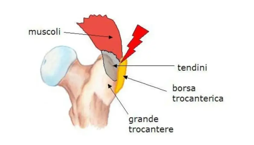 Diagramma anatomico dell'anca che mostra il grande trocantere, i muscoli, i tendini e la borsa trocanterica, evidenziando un'area di potenziale infiammazione.