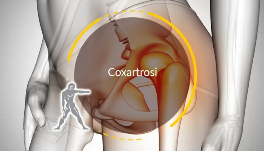 Illustrazione anatomica che evidenzia la coxartrosi, causa di dolore all'anca. I sintomi possono variare.