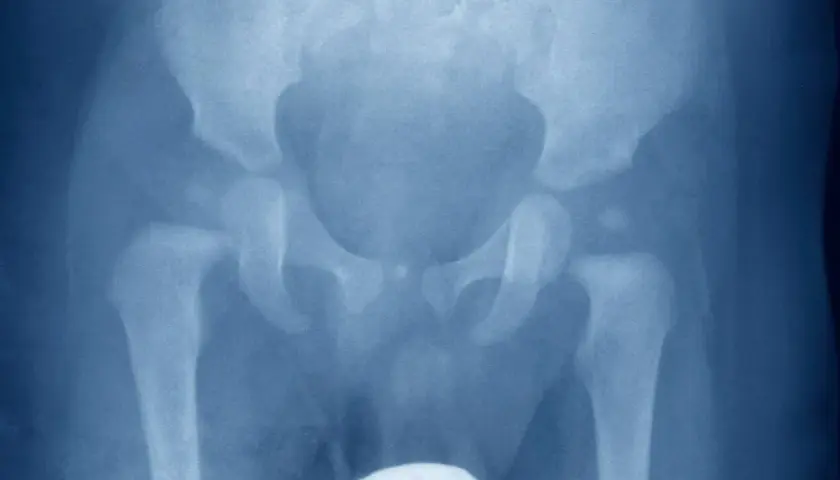 Radiografia del bacino e delle anche, evidenzia un'osteocondrosi dell'anca, con alterazioni della testa del femore.