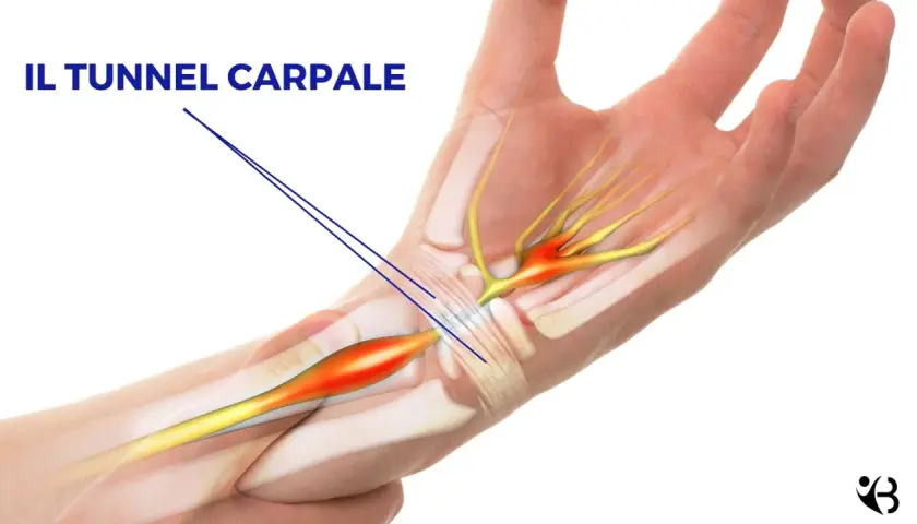 Illustrazione anatomica del tunnel carpale con evidenziata la compressione del nervo, che può richiedere un intervento.