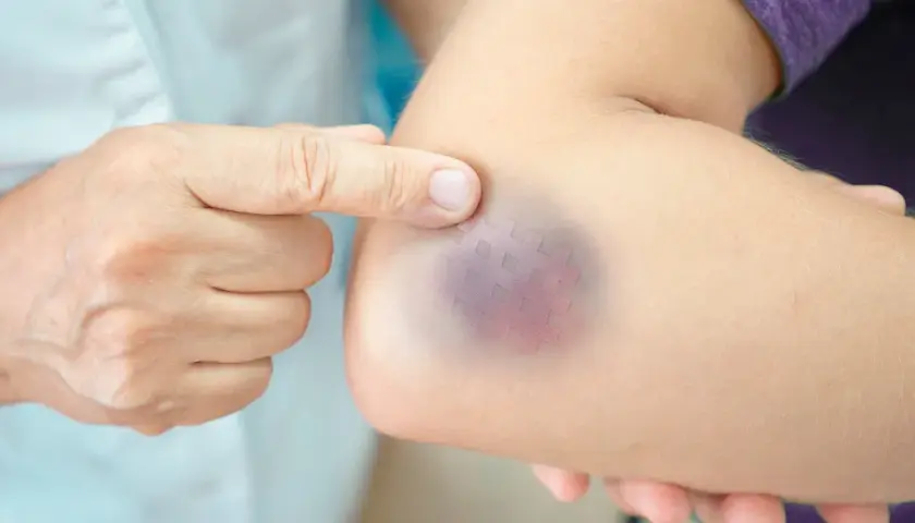 Dito un braccio con un livido viola e un cerotto a quadretti, segno di un trauma braccio dopo caduta.