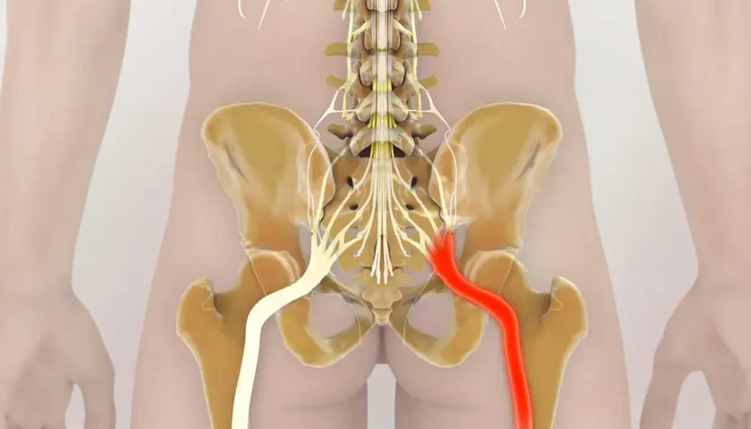Illustrazione anatomica del nervo sciatico, con enfasi sui **sciatalgia sintomi inguine**. Il nervo destro è evidenziato in rosso, indicando potenziale irritazione o infiammazione.