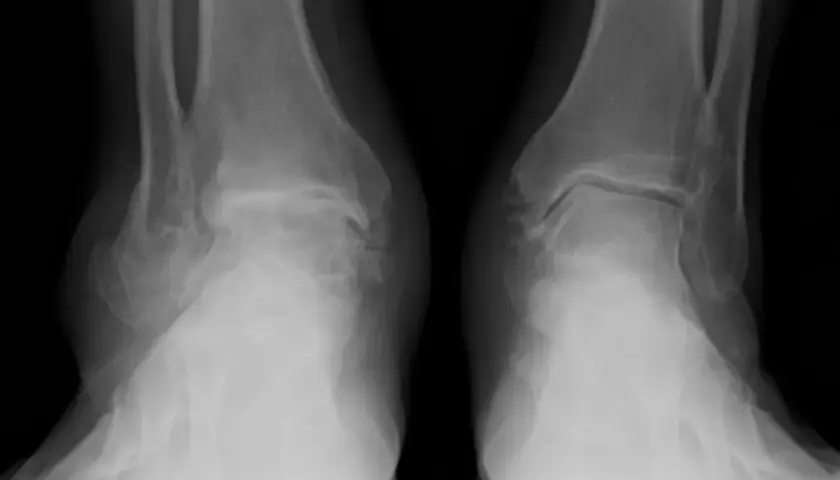 Radiografie delle caviglie mostrano segni di artrosi, con alterazioni ossee e riduzione dello spazio articolare.