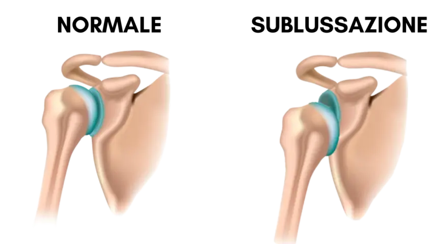 Spalla normale vs. sublussazione: quando il dolore spalla sinistra quando preoccuparsi? Illustrazione anatomica.