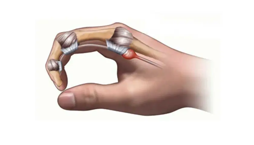 Dito cosa fare per il pollice a scatto: infiammazione del tendine e della guaina tendinea.